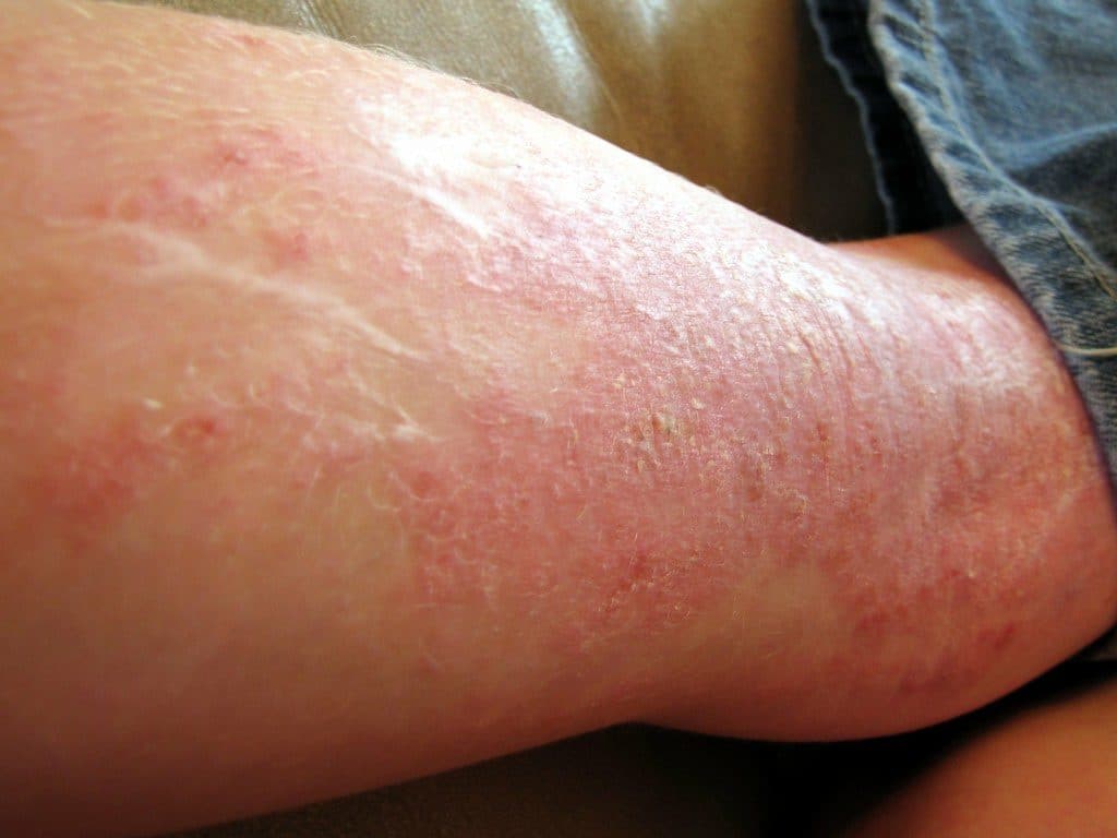 How Eczema Can Be Treated with Cannabis