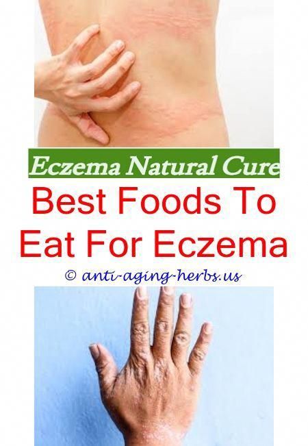 how eczema occurs how to calm down eczema flare ups ...