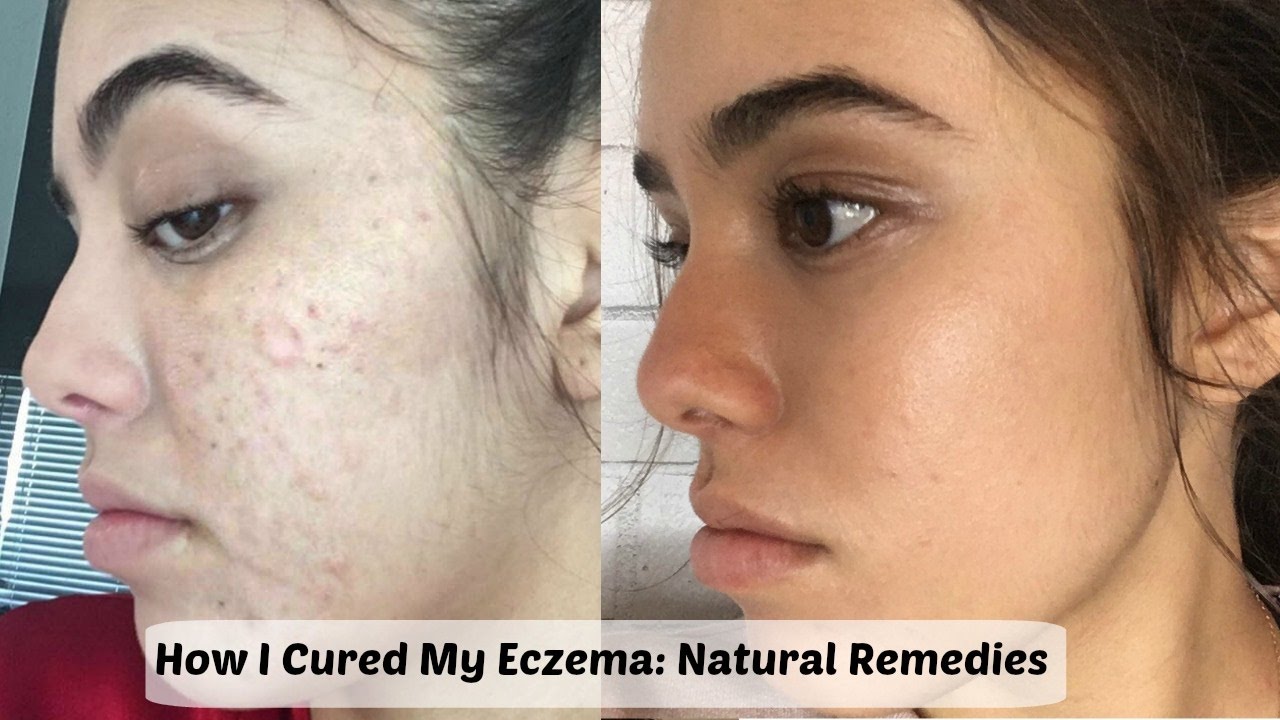 How I Cured My Eczema