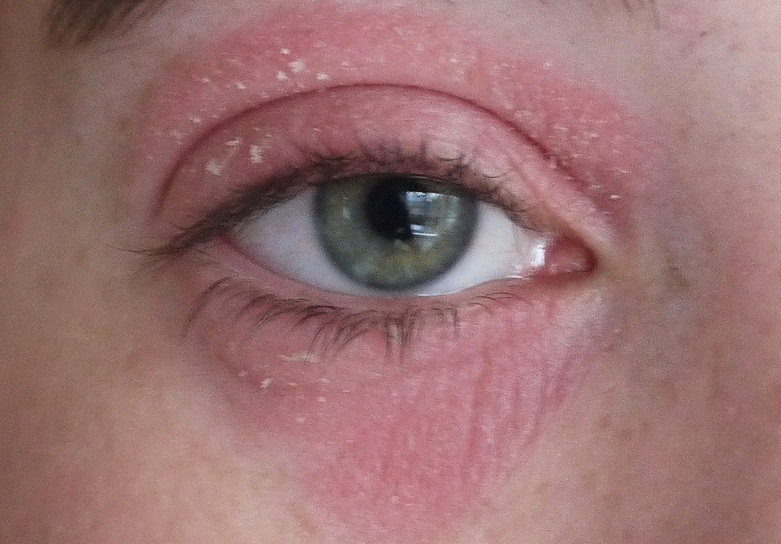 How I Got Rid of my Eye Eczema.