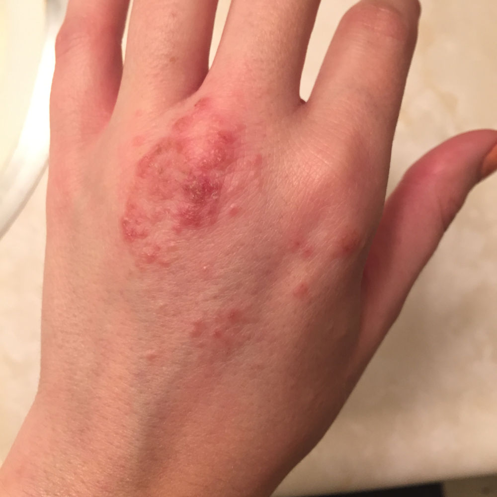 How I Healed My Eczema Naturally