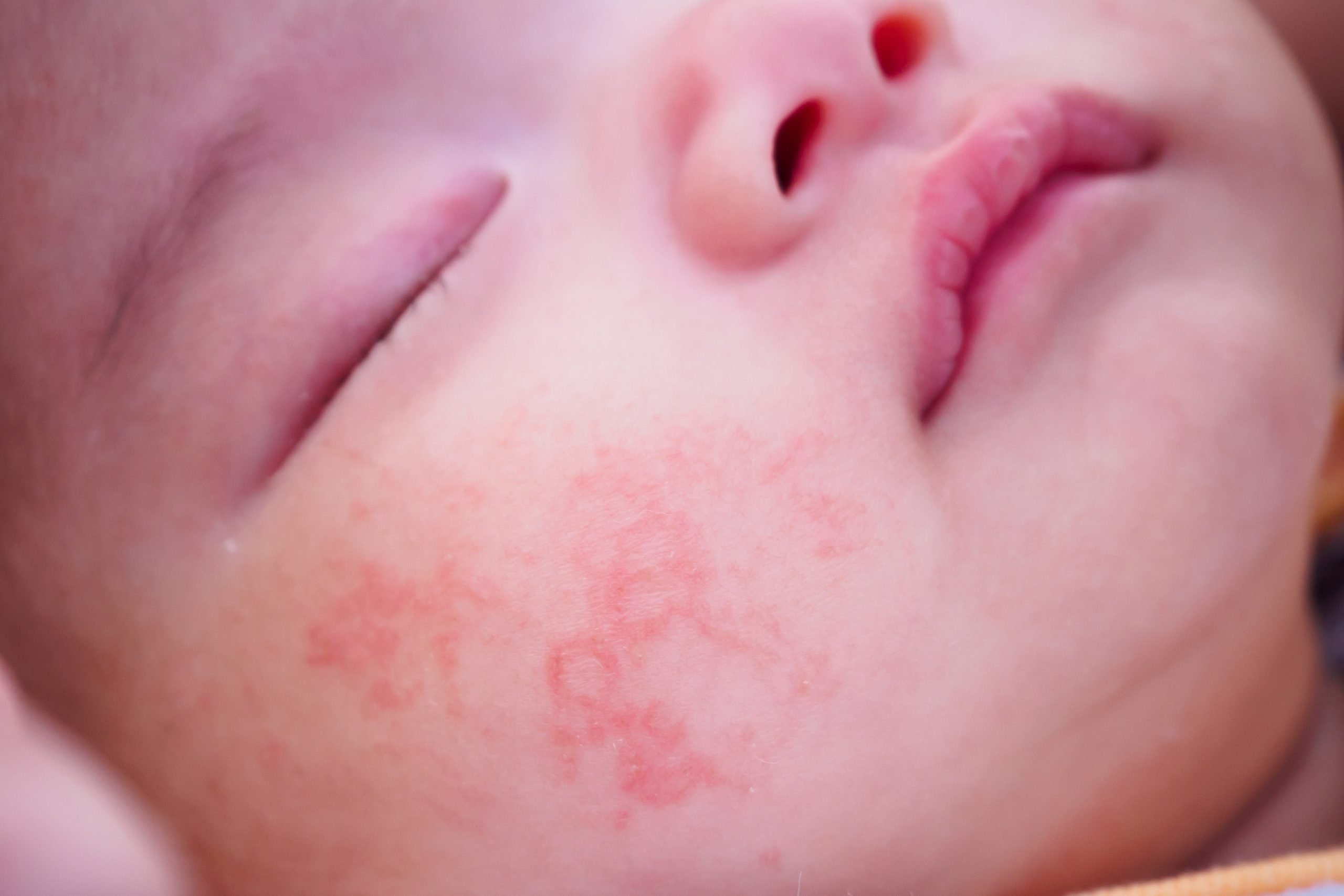 How I made infant eczema disappear within 4 weeks â Mummy ...