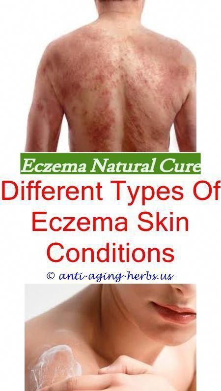 How long baby eczema last.Signs of eczema on hands.How to clear up ...