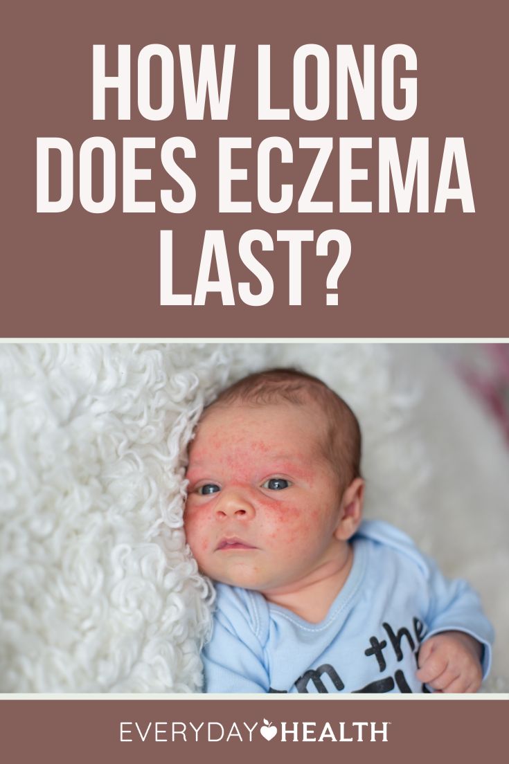 How Long Does Eczema Last?