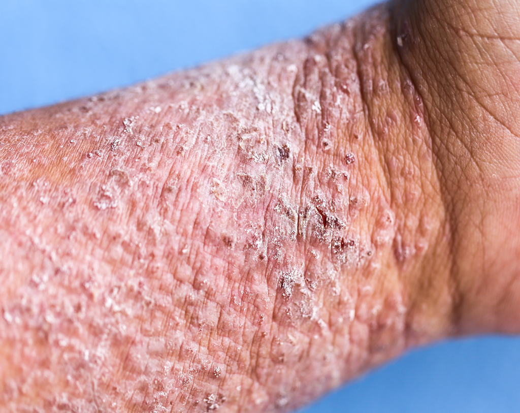 How many different types of Eczema are there: symptoms ...
