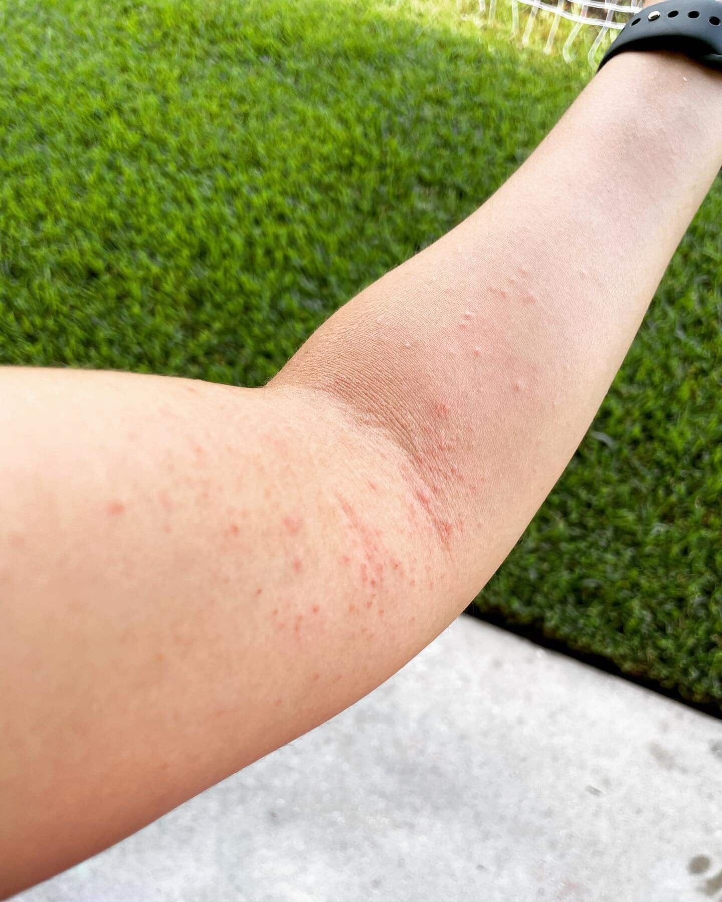How NOT to Deal with Eczema Bleeding â Itchy Pineapple