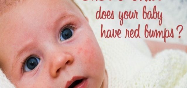 How To Clear Eczema In Babies