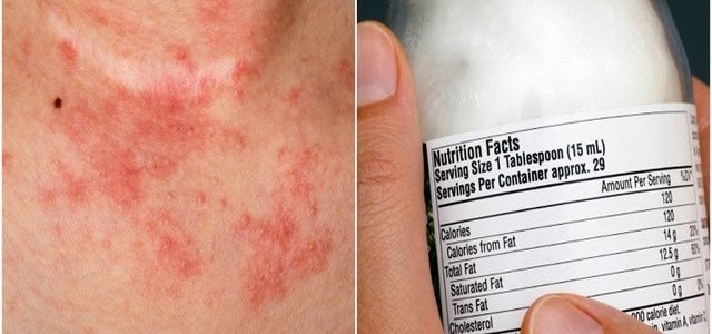 How To Clear Up Eczema Discoloration