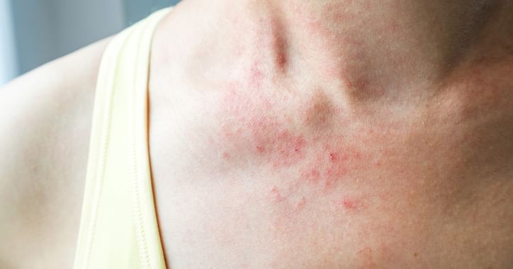 How to control an eczema flare up in summer