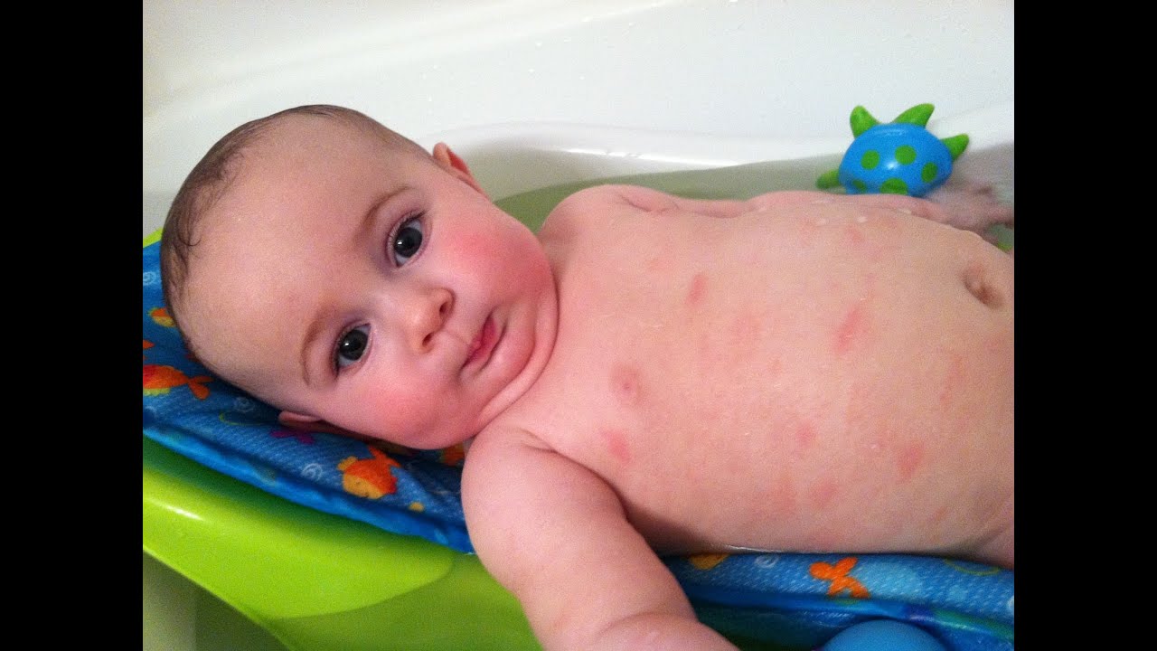 How To Cure Atopic Dermatitis In Babies