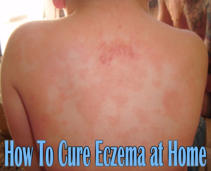 How To Cure Eczema at Home