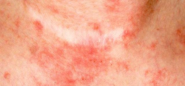 How To Cure Eczema Flare Ups