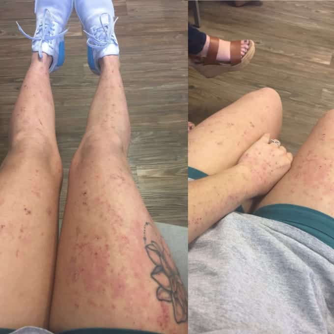 How To Cure Eczema On Legs