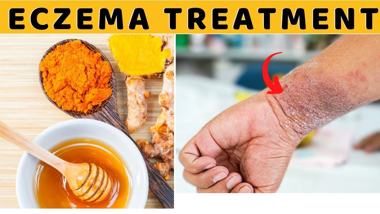 How to Cure Eczema Permanently Fast Naturally At Home