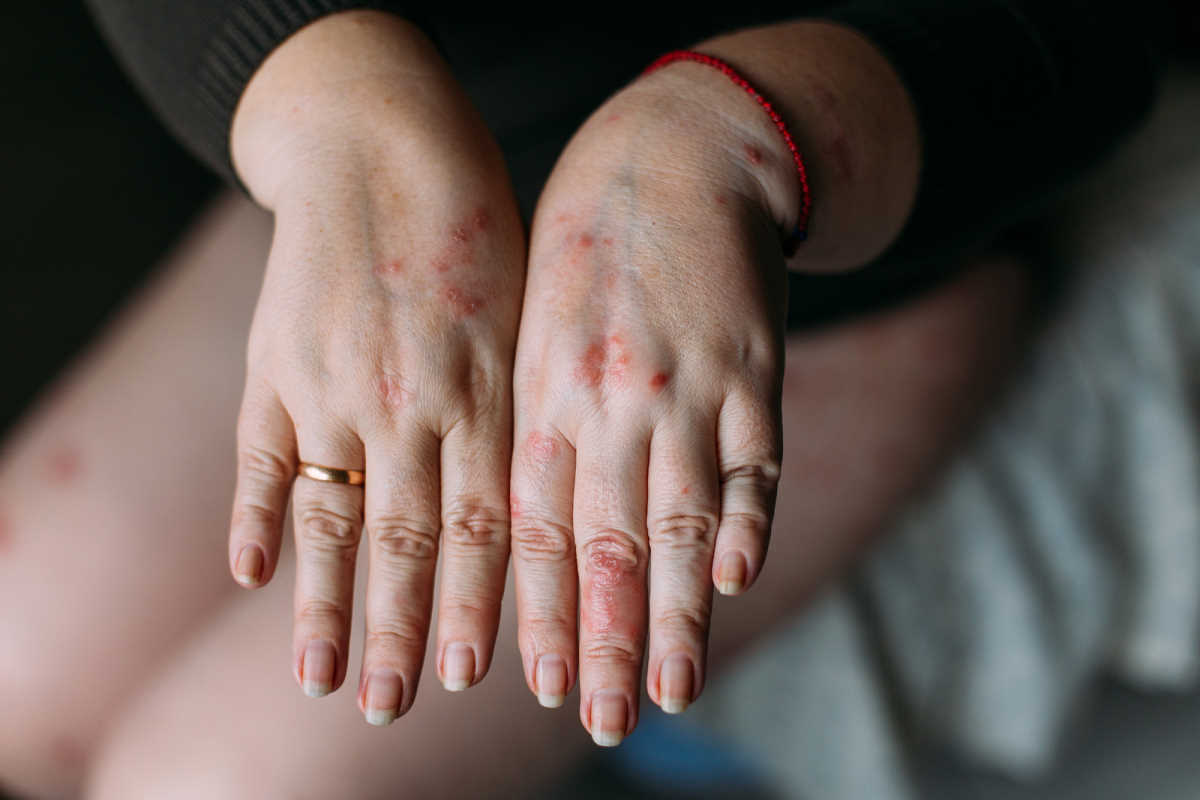 How to deal with eczema without going to a dermatologist ...