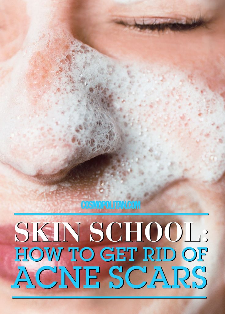 How to Fade Those Annoying AF Acne Scars