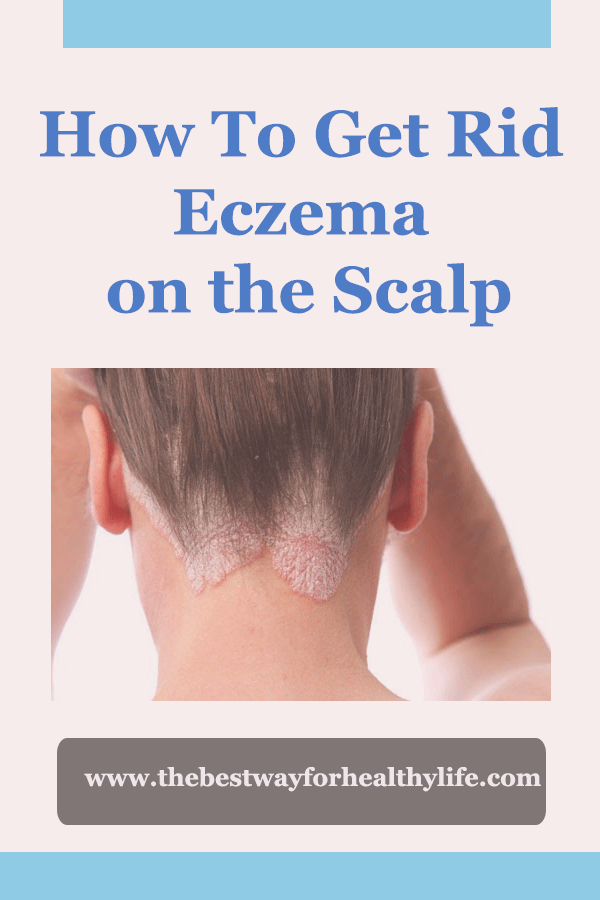 How To Get Rid Eczema on the Scalp