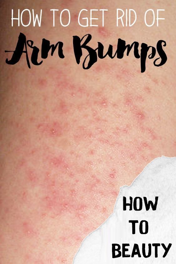 How To Get Rid Of Arm Bumps a.k.a keratosis pilaris or ...