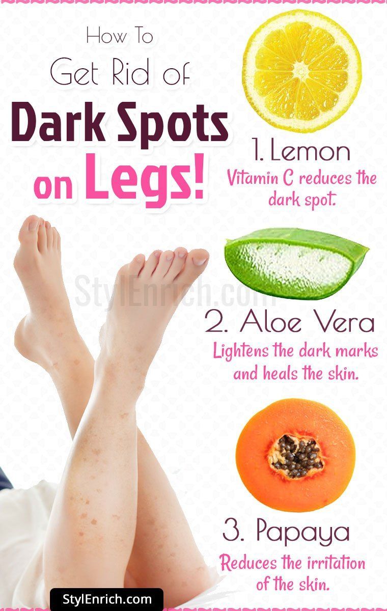 How to Get Rid of Dark Spots on Legs?