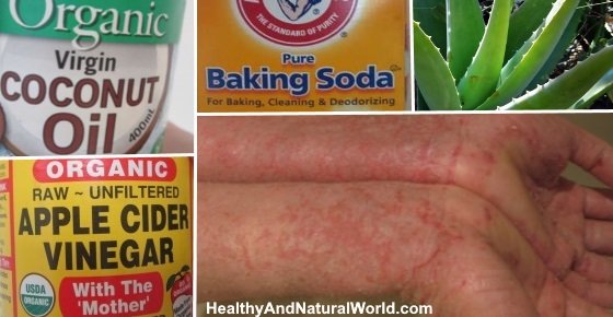 How To Get Rid Of Eczema: 13 Natural Remedies Backed By ...