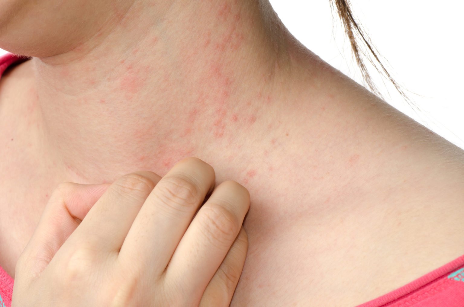 How To Get Rid Of Eczema Forever