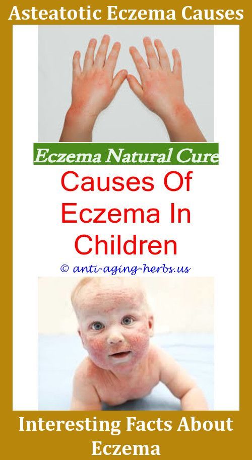 How To Get Rid Of Eczema How Often Does Eczema Occur Skin ...