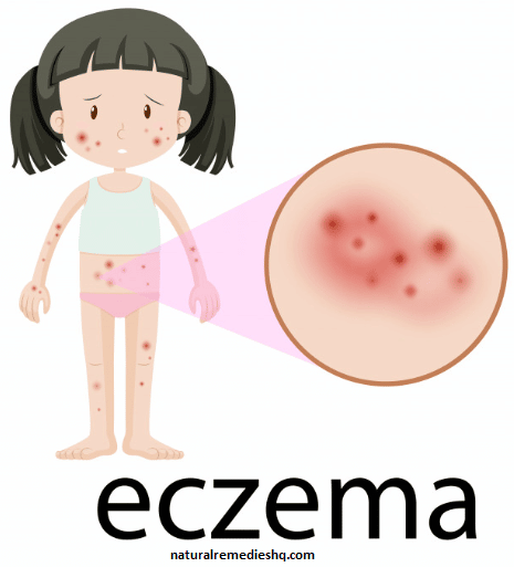 How to get rid of Eczema naturally â Natural Remedies