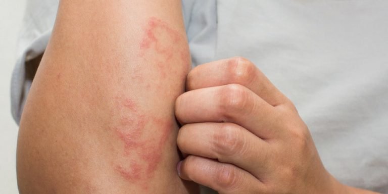 How To Get Rid Of Eczema Naturally?