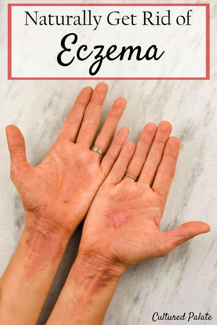 How to Get Rid of Eczema Naturally #eczemasolutions