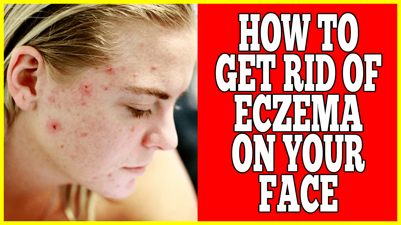 How To Get Rid OF Eczema On Face