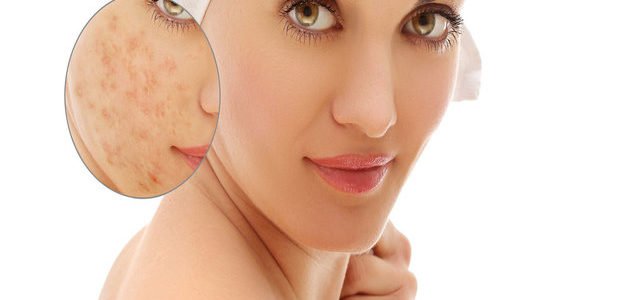How To Get Rid Of Eczema On Face Fast