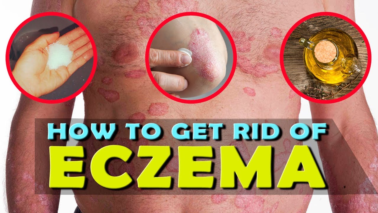 How to get rid of eczema on hands and face naturally ...