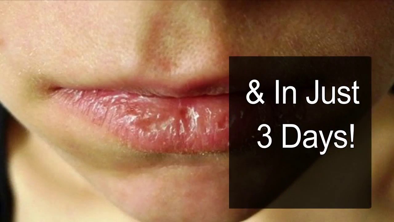 how to get rid of eczema on lips fast