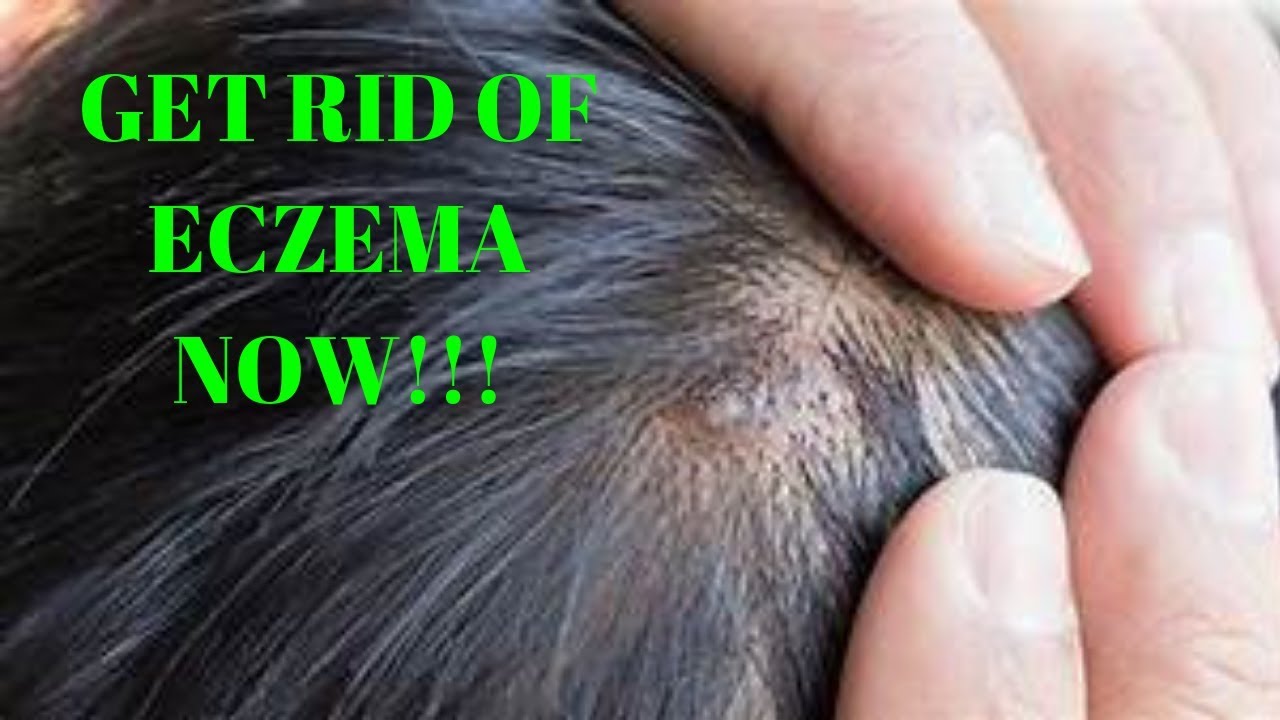 how to get rid of eczema on scalp
