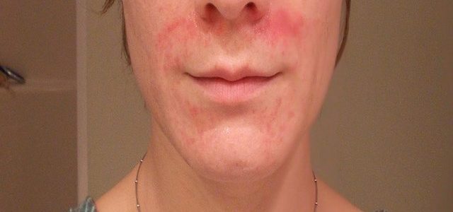 How To Get Rid Of Eczema On Your Face