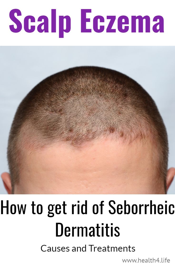 How to get rid of eczema on your head or scalp. Seborrheic Dermatitis ...