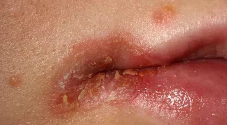 How To Get Rid Of Eczema On Your Lips