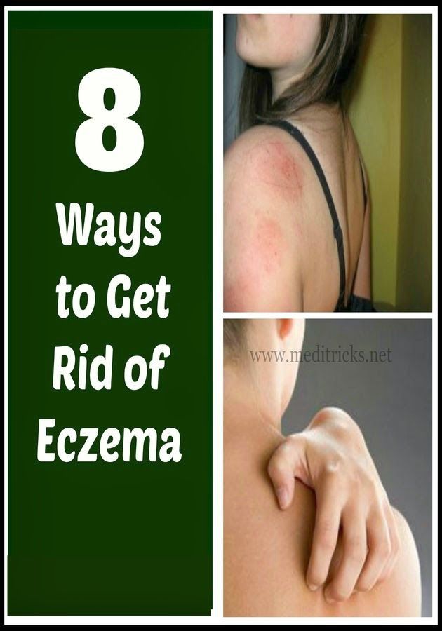 How To Get Rid Of Eczema Patches On Legs