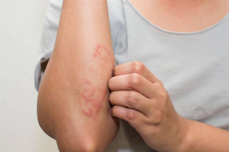 How to Get Rid of Eczema Scars Naturally at Home?