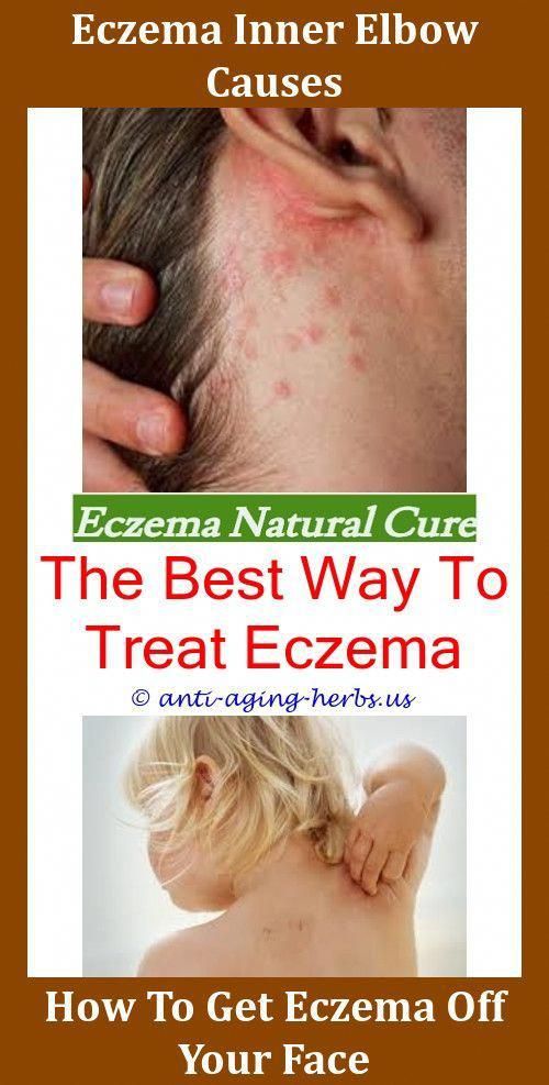How To Get Rid Of Eczema Scars On Legs
