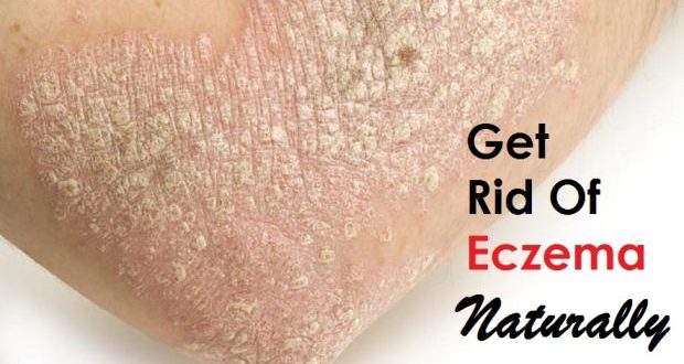How to Get Rid of Eczema?