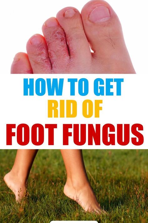 How to Get Rid of Foot Fungus â Home Remedies â Treatments