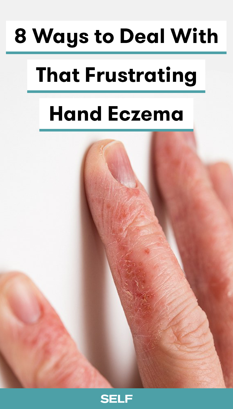 How To Get Rid Of Itchy Rash On Hands â Mednifico.com