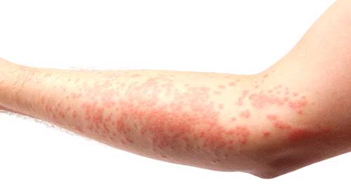 How to Get Rid of Itchy Skin Rashes or Allergies