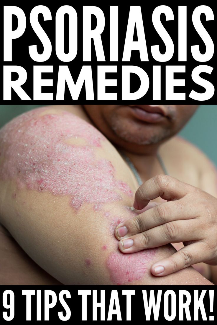 How to Get Rid of Psoriasis: 9 Tips and Remedies to Try ...