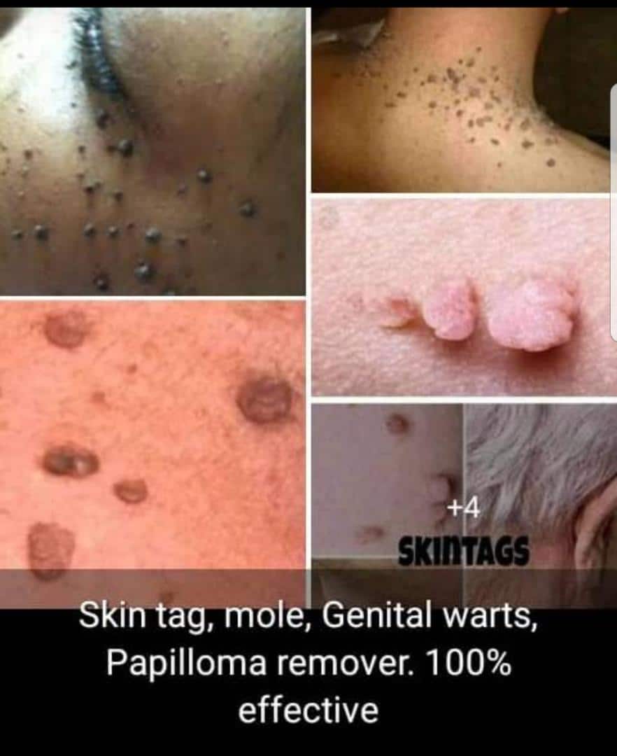 How To Get Rid Of Skin Tags, Genital Warts And Mole