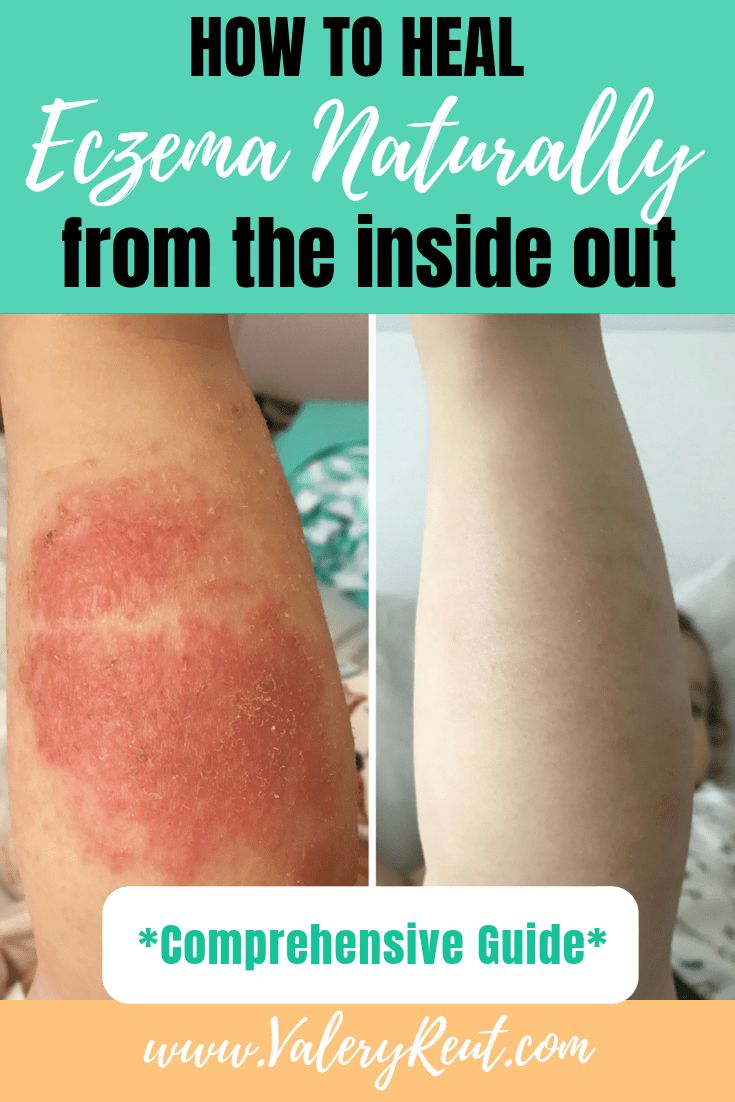 How to Heal Eczema Naturally From The Inside Out