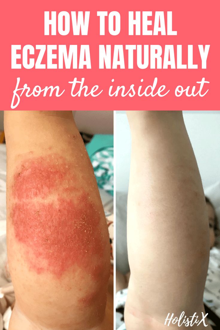 How to Heal Eczema Naturally From The Inside Out (With images ...