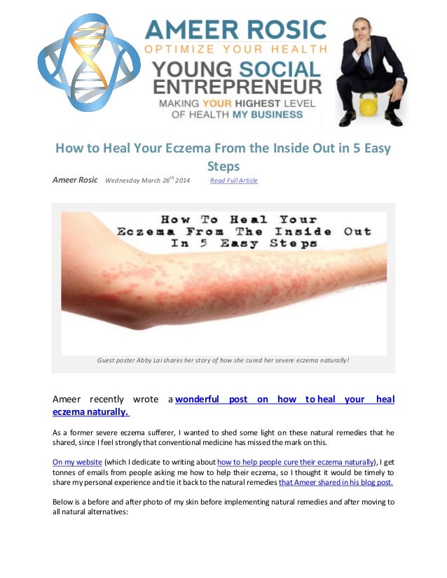 How to Heal Your Eczema From the Inside Out Naturally in 5 Easy Steps