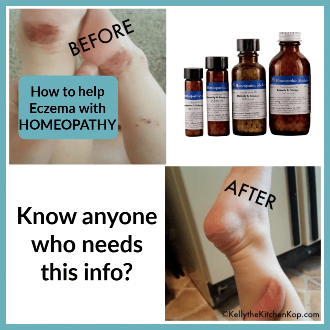 How to Help Eczema with Homeopathy (Another success story)